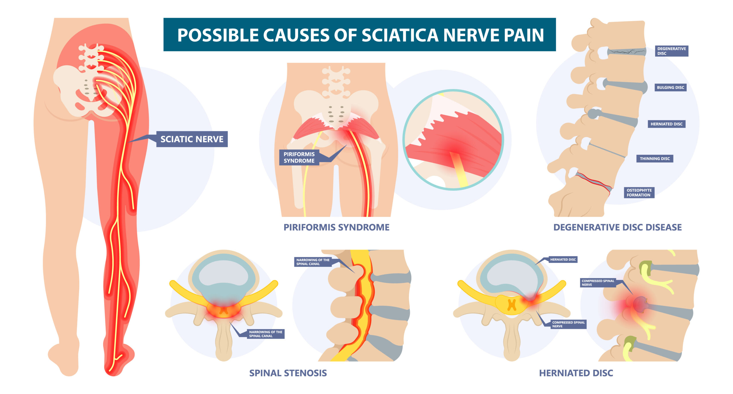 Sciatica Pain Relief With Massage And Chiropractic Treatment