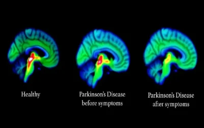 Chiropractic Care, Parkinson’s Disease and Multiple Sclerosis