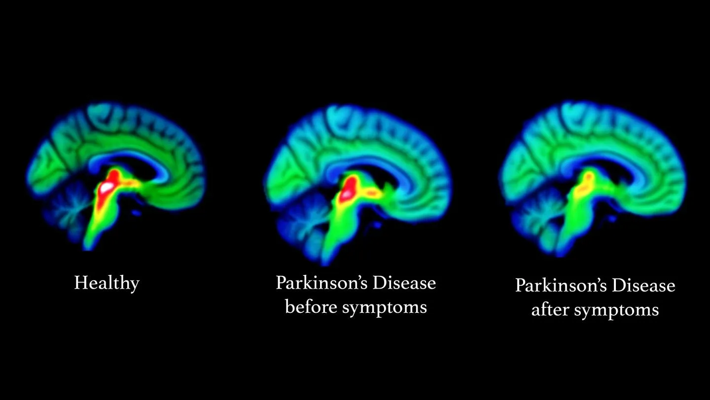 Parkinson's disease and Multiple Sclerosis