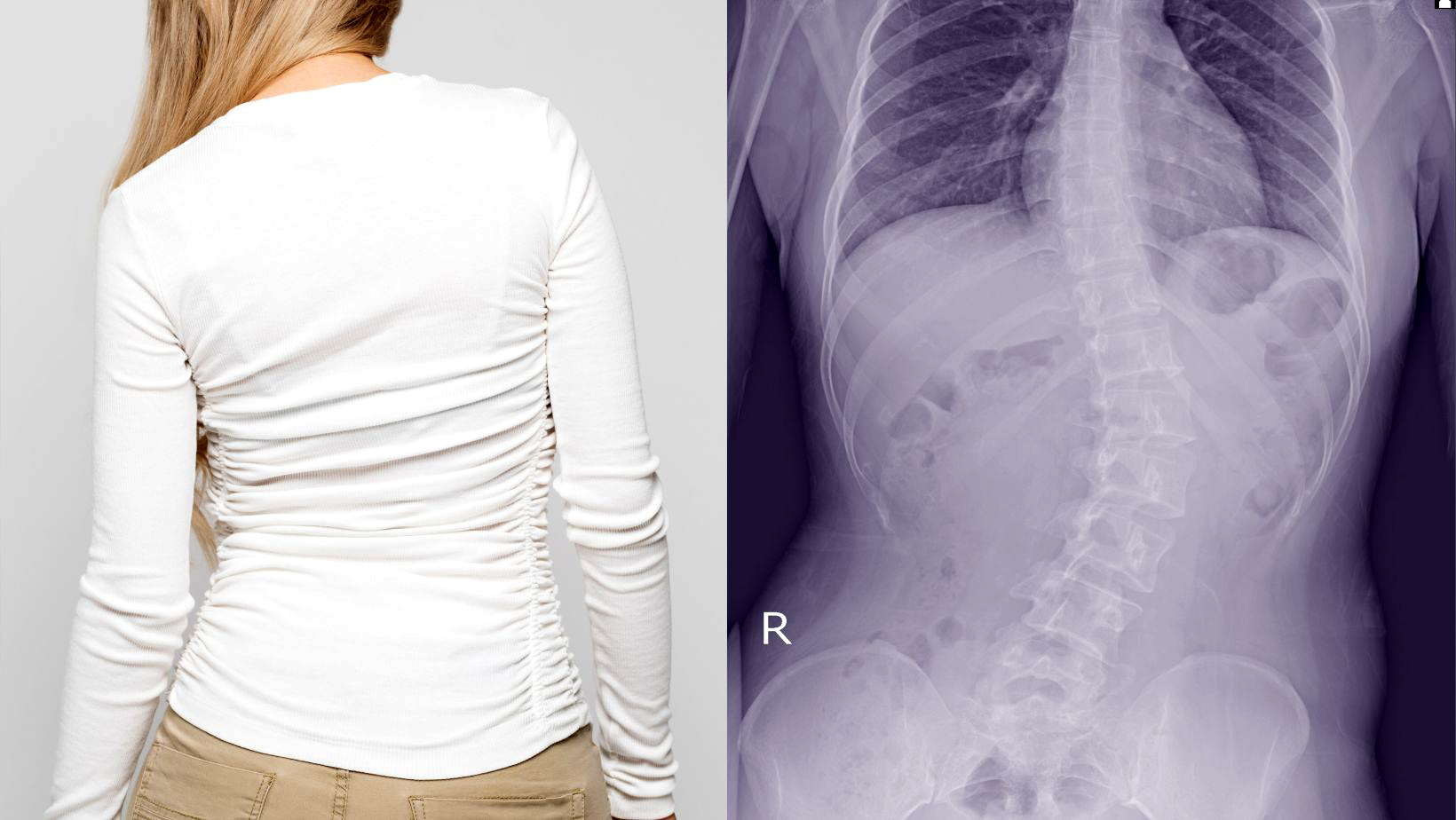 Correct Scoliosis 