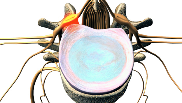 Pinched Nerve Diagram